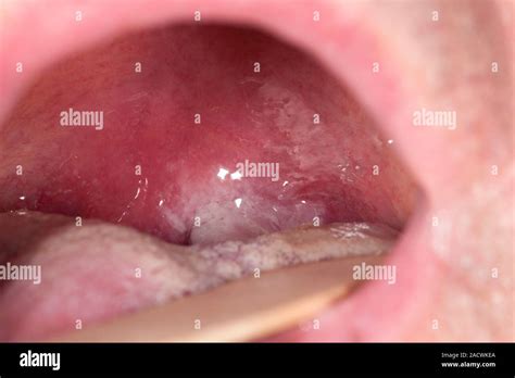 Infected Tonsil Of A 63 Year Old Male Patient With Quinsy Or