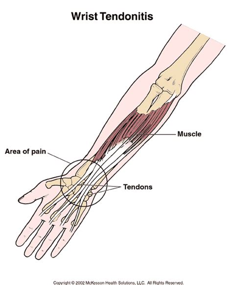 Case contributed by dr roberto schubert. Sports Medicine Advisor 2003.1: Wrist Tendonitis: Illustration