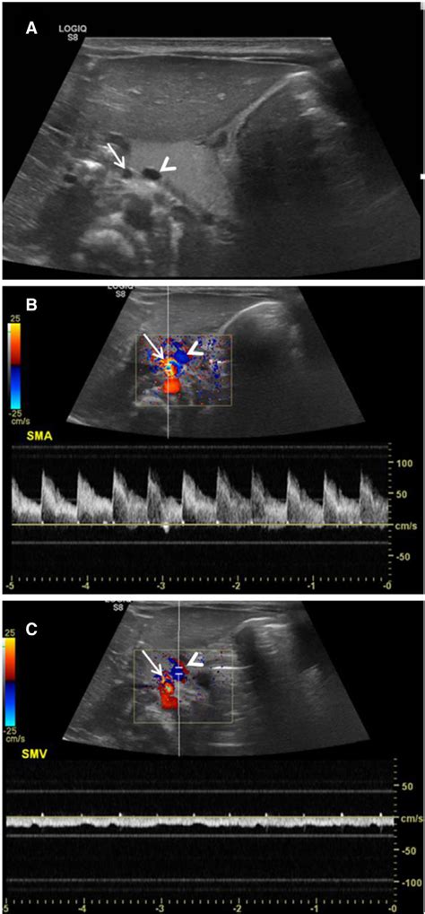 Abdominal Ultrasound Demonstrating The Reversed Relationship Of The SMA