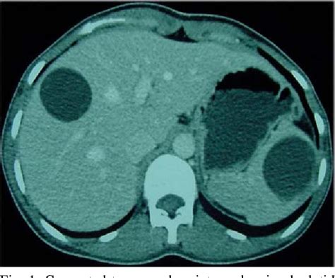 Figure 1 From Simultaneous Primary Hydatid Cysts Of Liver And Spleen