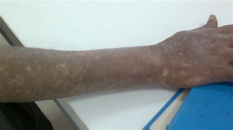 Erythema Dyschromicum Perstans Auctores