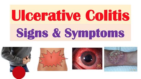 Ulcerative Colitis Signs And Symptoms And Why They Occur And