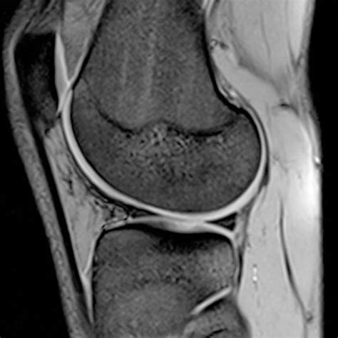 Sagittal View Of The Knee Shows A Normal Meniscus B Medial