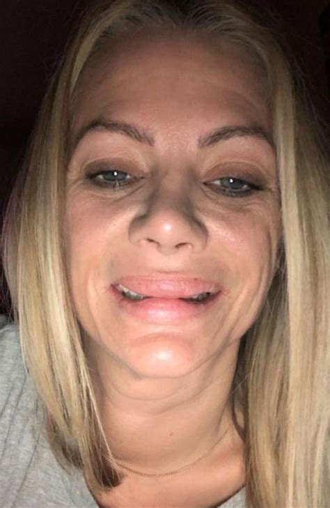 Mum Left With ‘overinflated Barbie Lips After Botched Surgery Photo