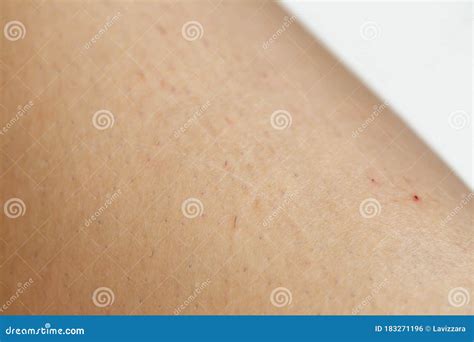 Irritated Skin And Ingrown Hair After Shaving Legs Stock Photo Image