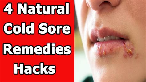 4 Natural Cold Sore Remedies Hacks That Work Youtube