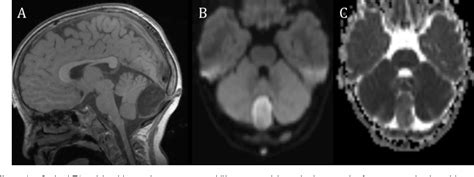 Figure 1 From Spontaneous Cervical Epidural Hematoma Mimicking Stroke