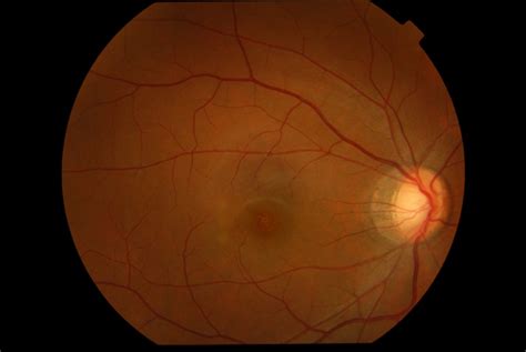 Acute Retinal Pigment Epitheliitis Krill Disease Eyewiki