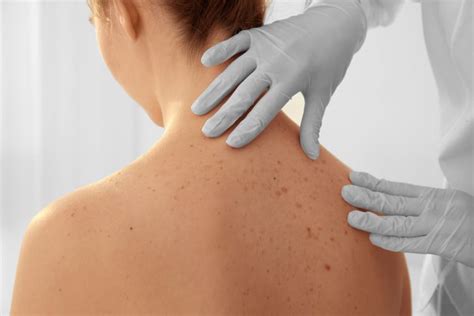 Skin Cancer Premier Dermatology Atlanta