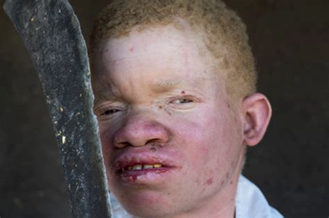 Malawi High Court To Rule On The Killing Of A Man With Albinism Human