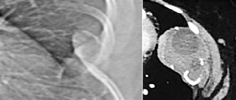 Ab Hydatid Rib A Conventional B Ct Showing Daughter Cysts