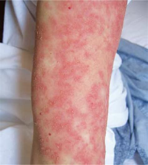 The Typical Skin Lesions Of Agep In Our Patient Download Scientific