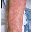 The Typical Skin Lesions Of AGEP In Our Patient  Download Scientific