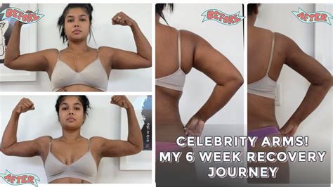 I Did Celebrity Arms Lipo Alone My Experience Week Recovery Youtube