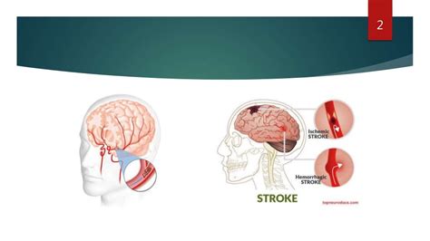 Case Presentation On Cerebrovascular Accident Stroke