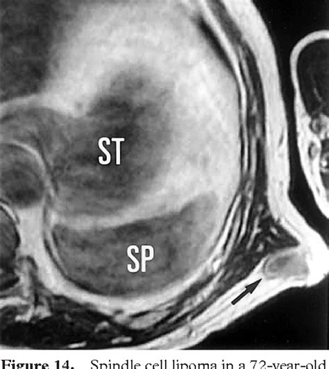 Pdf Chest Wall Tumors Radiologic Findings And Pathologic Correlation