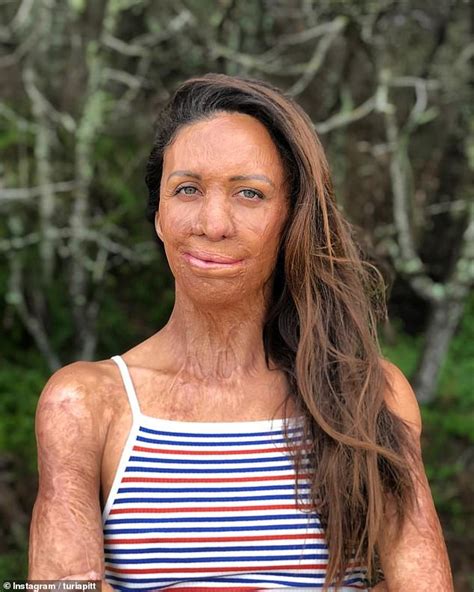 Turia Pitt Reveals That She Was Bullied At A Pool While Training For An