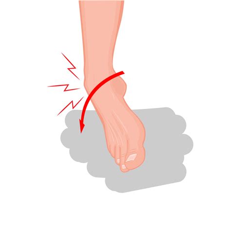 Lateral Ankle Sprain Diagnosis Causes And Treatments