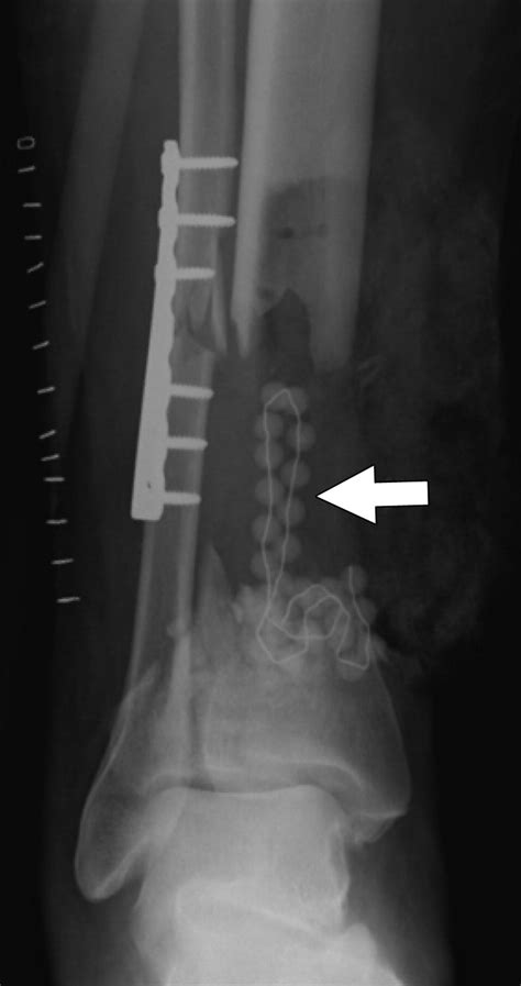 The Radiology Of Antibiotic Impregnated Cement Ajr