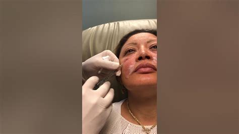 Juvederm Bruise Free Injections To Tear Troughs Youtube