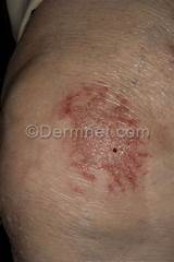 Eczema Skin Disease Treatment Pictures
