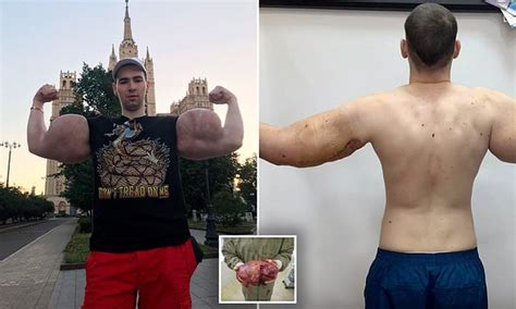 Popeye Bodybuilder Has 3lb Of Dead Muscle Removed By Surgeons Daily Mail Online