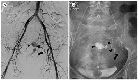 Angiographic Embolization Of A Postpartum Vulvovaginal Hematoma In A