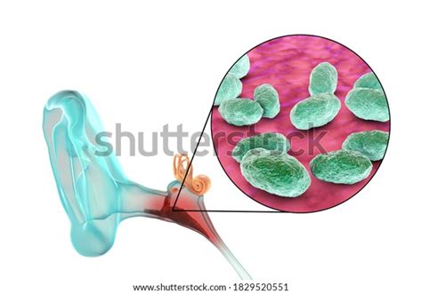 Otitis Media Caused By Bacteria Haemophilus Stock Illustration