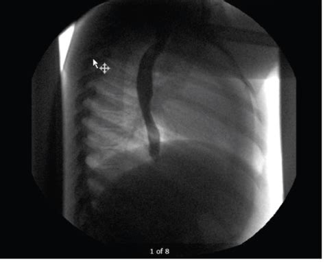 Treatment Of Caustic Ingestion Associated Esophageal Stricture With