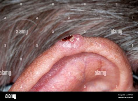 Close Up Of Basal Cell Carcinoma Bcc Or Rodent Ulcer On The Ear
