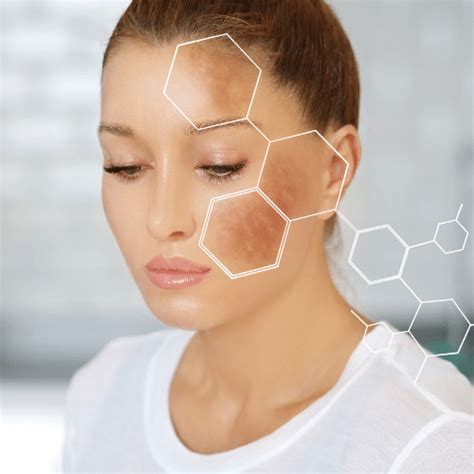 Brown Splotches On Face Causes And Treatment 2022 Glow Zone