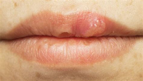 Hiv Mouth Sores Pictures Causes Treatment And Prevention Free