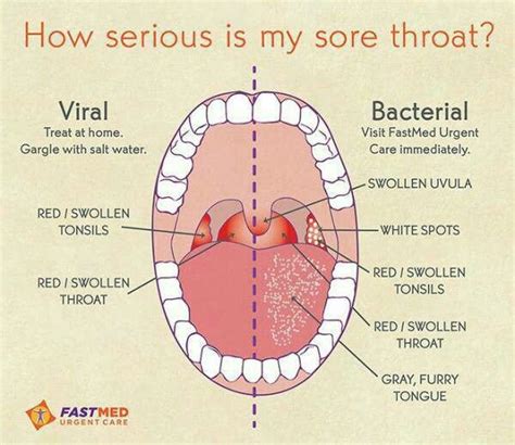 How Serious Is Your Sore Throat Sick Remedies Cough Remedies