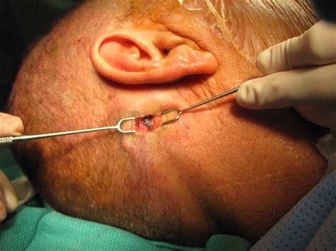 Cervical lymph nodes (lymph nodes in the neck) in turn, can be broken down into three primary regions, and which region is involved can give occipital lymph nodes: Case Example Sentinel Lymph Node Biopsy | Iowa Head and ...