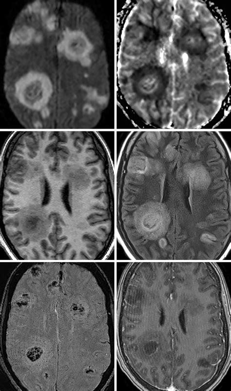 Aspergillosis The Neurosurgical Atlas By Aaron Cohen Gadol M D