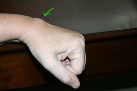 What Is A Ganglion Cyst Is Ganglion Cyst Treatment Necessary Ganglion