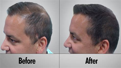 Natrol nuhair hair regrowth for men. Hair Regrowth for Men Naturally | Health Blog