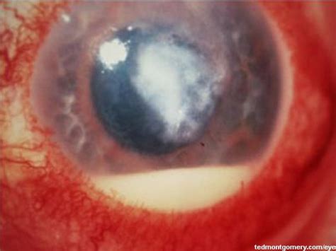 Corneal Ulcer Hypopyon