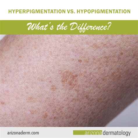 Hyperpigmentation Vs Hypopigmentation Whats The Difference