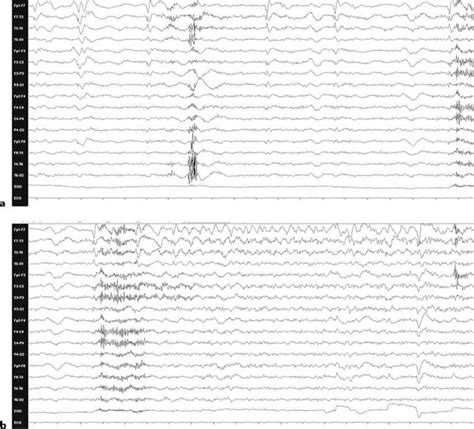 A Eeg With Left Frontotemporal Periodic Lateralized Epileptiform