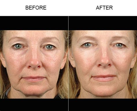 Thermacool Florida Florida Thermage Non Surgical Face Lift Orlando