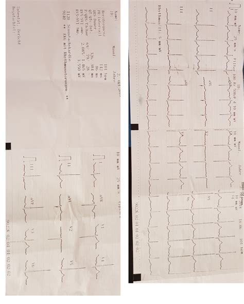Lesen sie mehr über ursachen, symptome, risiken und behandlung der myokarditis. EKG Befund, falsch angelegt? (Gesundheit, Gesundheit und ...