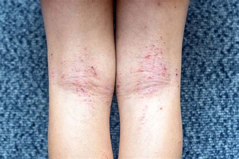 6 Tipos De Eczema Causas Sintomas E Tratamento Mdsaúde