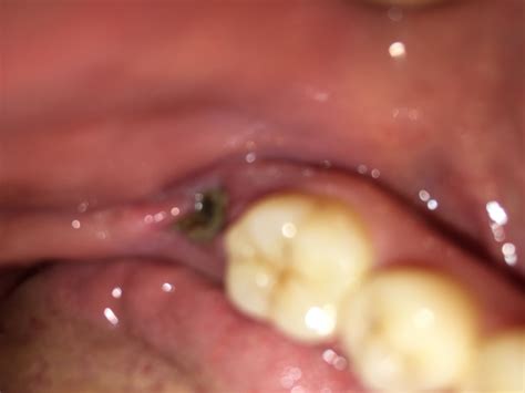 Sore Adjacent Tooth After Extraction