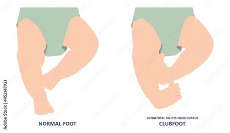 Obraz W Ramie Foot Deformities Infant Turned Inward Upward Birth Baby