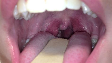 Sore Throat Causes And Symptoms My Best Dentists Journal