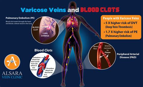 Blood Clots And Varicose Veins 5x Higher Risk Alsara
