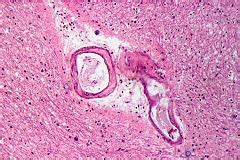 File Cerebral Arteriolosclerosis HE Wikimedia Commons