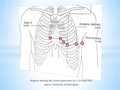 Picture Of 12 Lead Ecg Placement Rc Nachtflug Photos Real Pictures Of