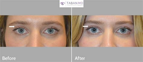 Eyelid Filler Injection Before And After Gallery Taban Md